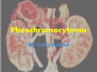 Pheochromocytoma