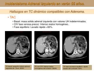 Hallazgos en TC dinámico compatibles con Adenoma.