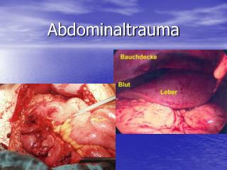 Abdominaltrauma