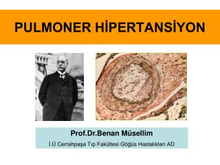 PULMONER HİPERTANSİYON