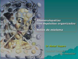 Glomerulopatías con depósitos organizados Riñón de mieloma