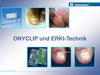 ONYCLIP und ERKI-Technik