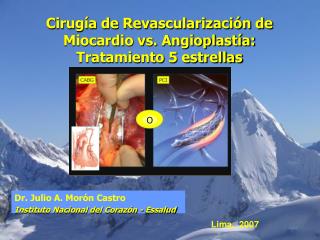 Cirugía de Revascularización de Miocardio vs. Angioplastía: Tratamiento 5 estrellas