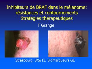Inhibiteurs de BRAF dans le mélanome: résistances et contournements Stratégies thérapeutiques