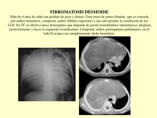 8._fibromatosis_desmoide