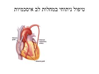 טיפול ניתוחי במחלות לב איסכמיות