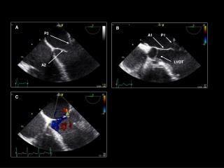 LVOT