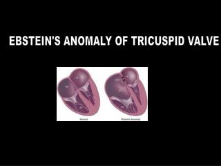 EBSTEIN'S ANOMALY OF TRICUSPID VALVE
