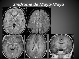 Sindrome de Moya-Moya
