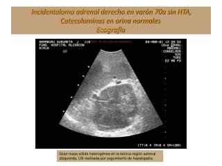 Incidentaloma adrenal derecho en varón 70a sin HTA, Catecolaminas en orina normales Ecografía