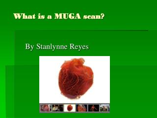 What is a MUGA scan?