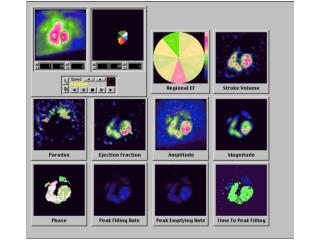 Multiple gated ventriculography, MUGA