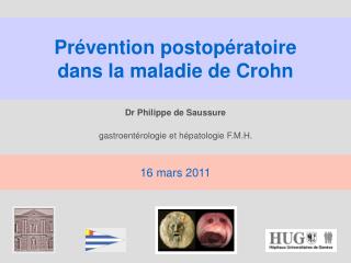 Prévention postopératoire dans la maladie de Crohn