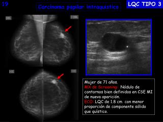 Carcinoma papilar intraquistico