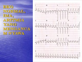 EKG NORMAL, IMA, ARITMIA YANG MENGANCAM NYAWA