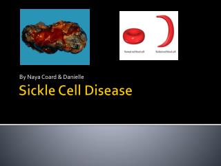 Sickle Cell Disease