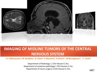 IMAGING OF MIDLINE TUMORS OF THE CENTRAL NERVOUS SYSTEM