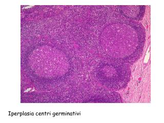 Iperplasia centri germinativi