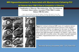 MRI Hyperenhancement is Associated with Myonecrosis Following PCI