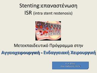Stenting: επαναστένωση ISR (intra stent restenosis)