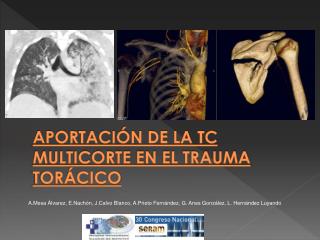 APORTACIÓN DE LA TC MULTICORTE EN EL TRAUMA TORÁCICO