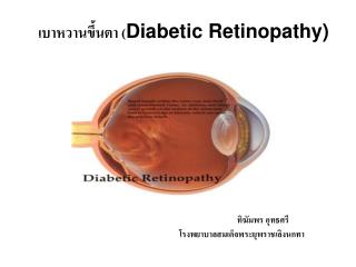 เบาหวานขึ้นตา ( Diabetic Retinopathy)