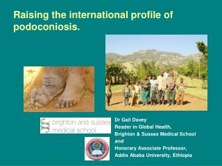 Raising the international profile of podoconiosis.