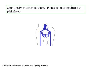 Shunts pelviens chez la femme: Points de fuite inguinaux et périnéaux.