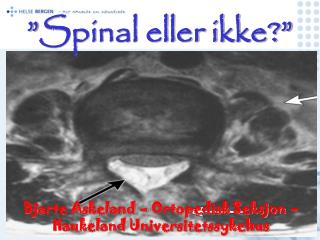 ” Spinal eller ikke? ”