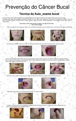 Prevenção do Câncer Bucal