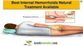 Best Internal Hemorrhoids Natural Treatment Available