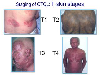 Staging of CTCL: T skin stages