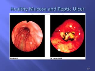 Healthy Mucosa and Peptic Ulcer