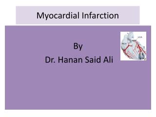 Myocardial Infarction