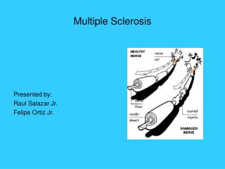 Multiple Sclerosis