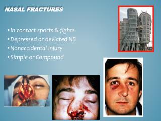 NASAL FRACTURES