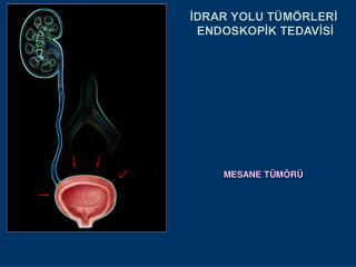 MESANE TÜMÖRÜ