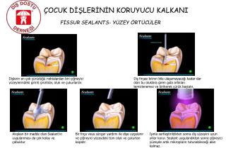 ÇOCUK DİŞLERİNİN KORUYUCU KALKANI