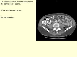 Let’s look at some muscle anatomy in the pelvis on CT scans.