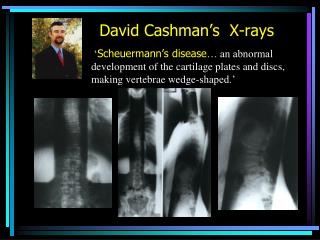 David Cashman’s X-rays