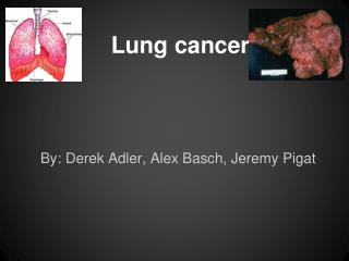 Lung cancer