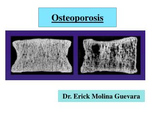 Osteoporosis