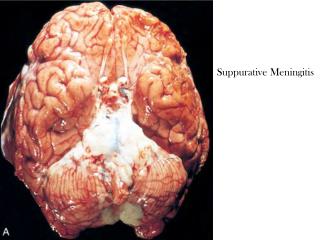 Suppurative Meningitis