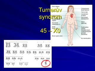 Turnerův syndrom 45 – X0