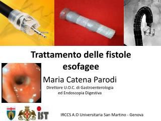 Trattamento delle fistole esofagee