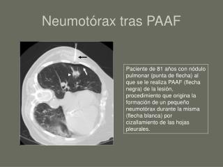Neumotórax tras PAAF