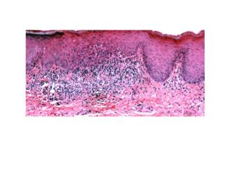 Hairy leukoplakia