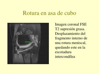 Rotura en asa de cubo