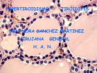 HIPERTIROIDISMO - TIROIDITIS