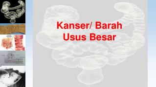 Kanser/ Barah Usus Besar